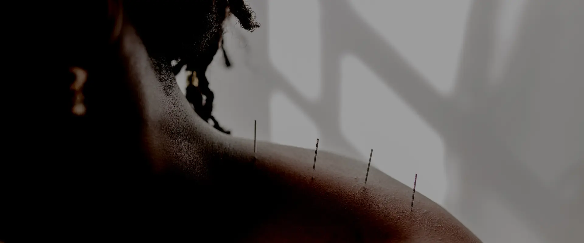 acupuncture Edmonton